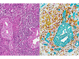 Two images displaying the same pancreatic ductal adenocarcinoma tissue. On the left is a standard H&E stain, showing the cell in pink. On the right is the advanced IHC stain, showing cells in purple, yellow, brown, and teal.